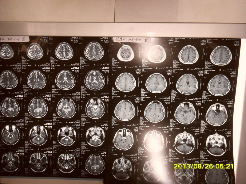最新治疗效果特别好的脑胶质瘤患者磁共振片对比