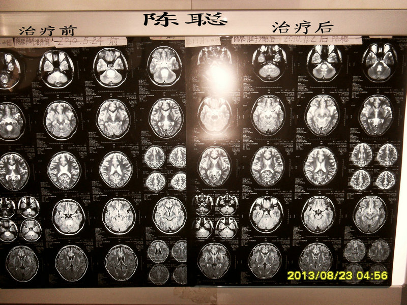 脑胶质瘤患者磁共振（源生疗法）治疗后对比